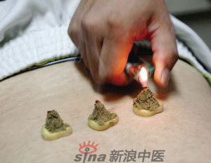 灸法的種類  你知道多少？